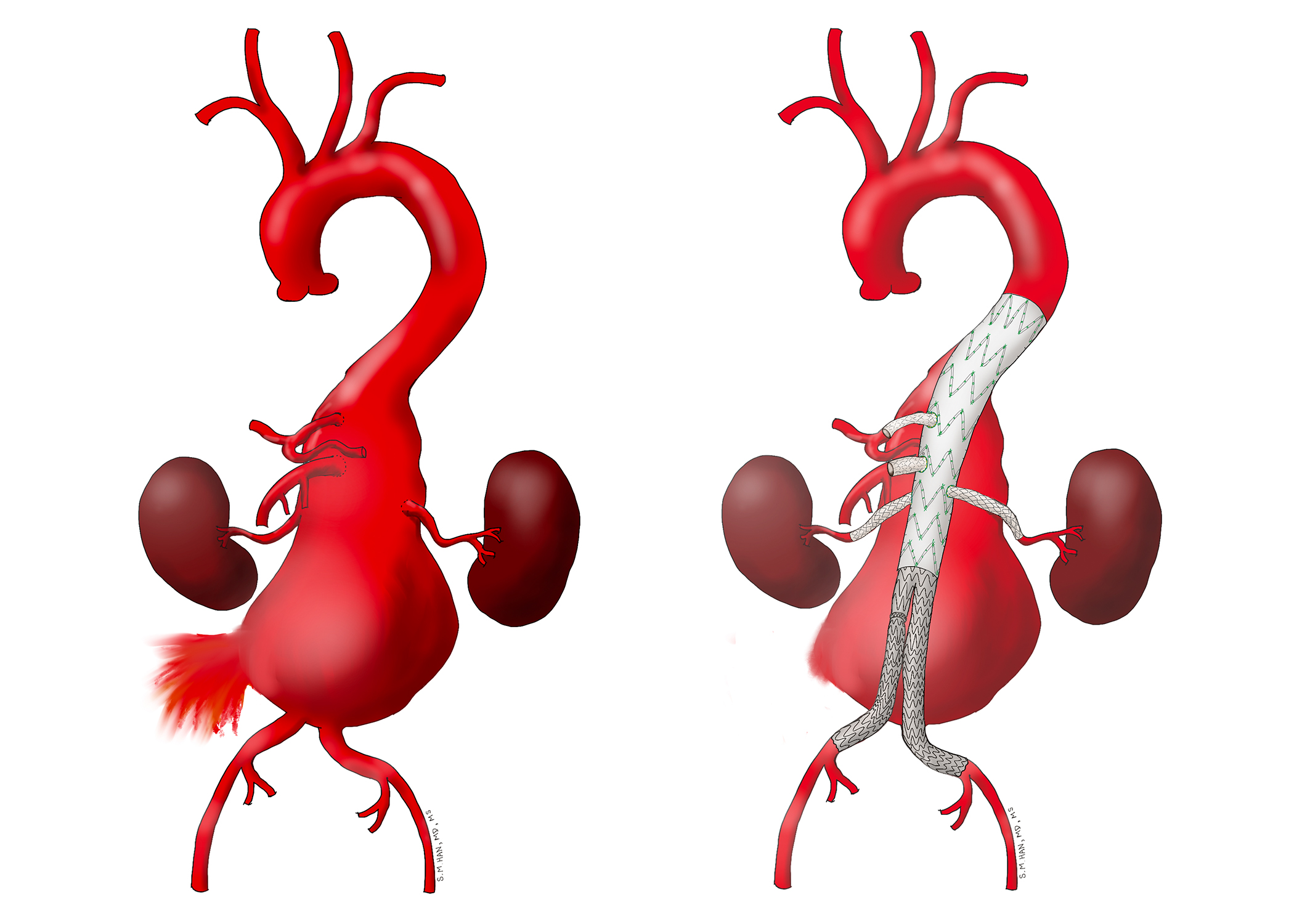 Endovascular repair of a thoracoabdominal aortic aneurysm (TAAA).
